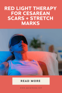 Image showing red light therapy for cesarean scars